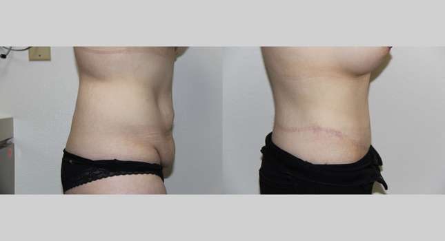 Body Lift: Image #717