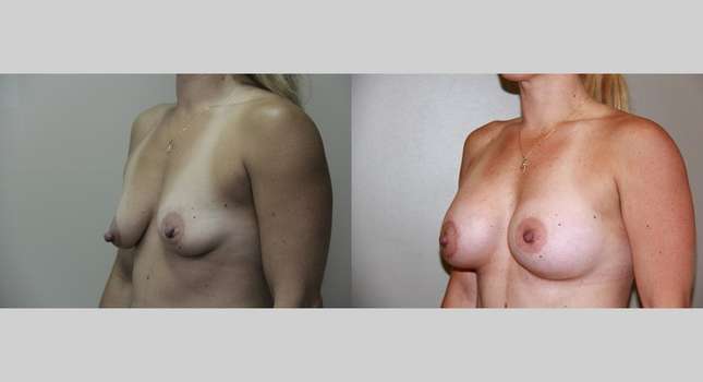 Mommy Makeover: Image #722