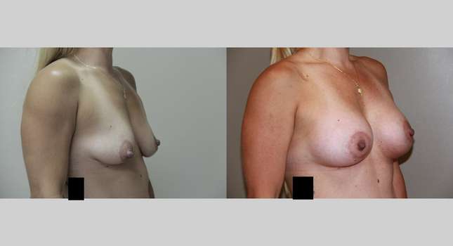 Mommy Makeover: Image #723