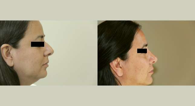 Nose Surgery: Image #728