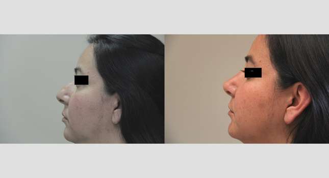 Nose Surgery: Image #729