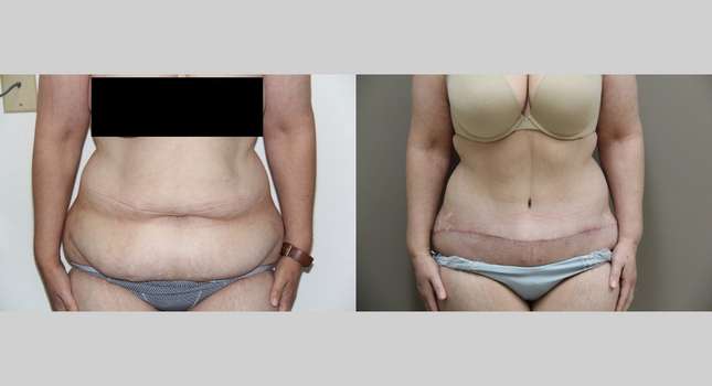 Tummy Tuck: Image #741