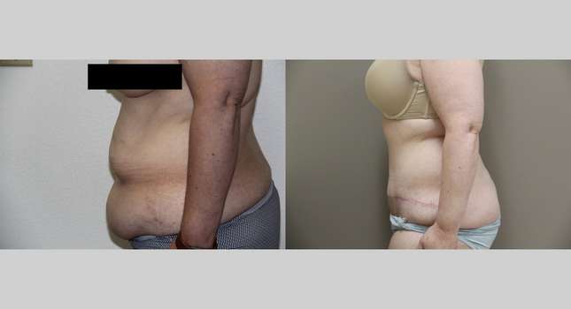 Tummy Tuck: Image #742