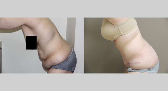 Tummy Tuck: Image #743
