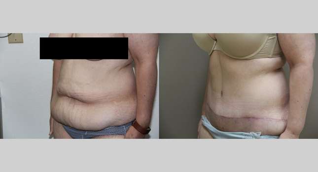 Tummy Tuck: Image #744