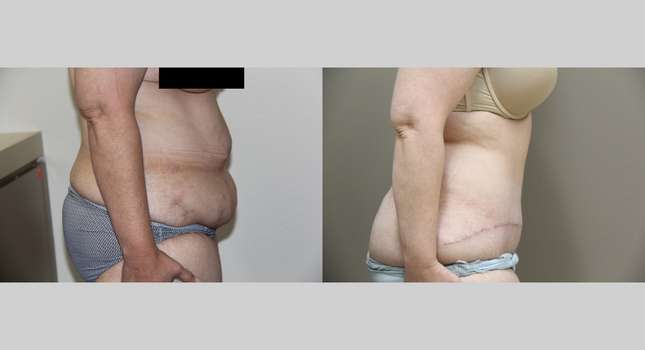 Tummy Tuck: Image #745