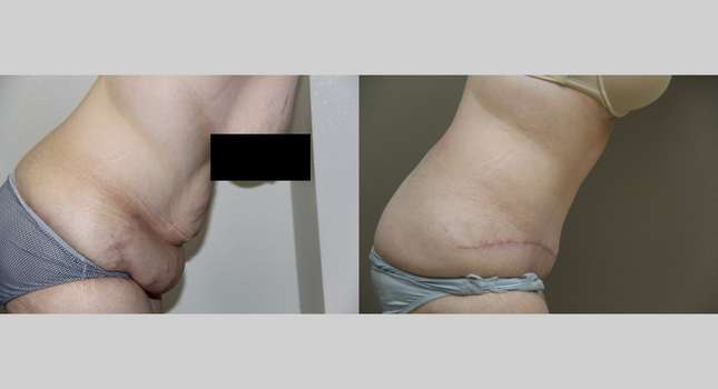 Tummy Tuck: Image #746