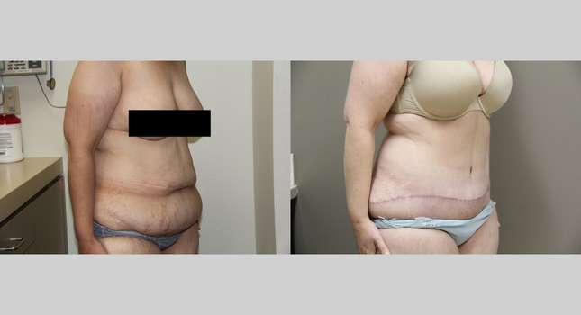 Tummy Tuck: Image #747