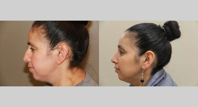 Nose Surgery: Image #748