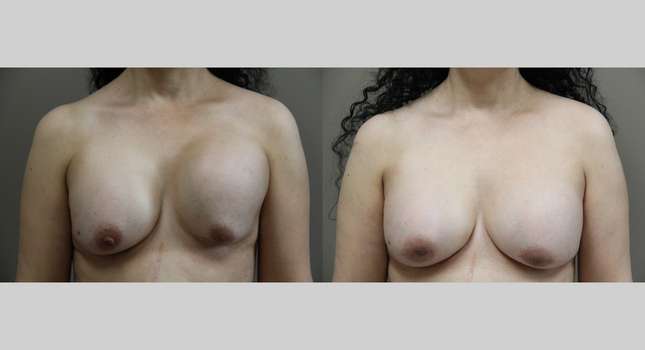 Breast Reconstruction: Image #749