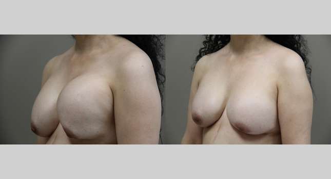Breast Reconstruction: Image #750