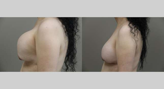 Breast Reconstruction: Image #751