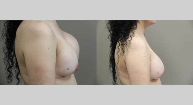Breast Reconstruction: Image #752