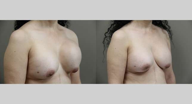 Breast Reconstruction: Image #753