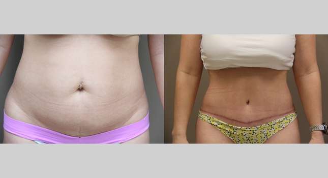 Tummy Tuck: Image #767