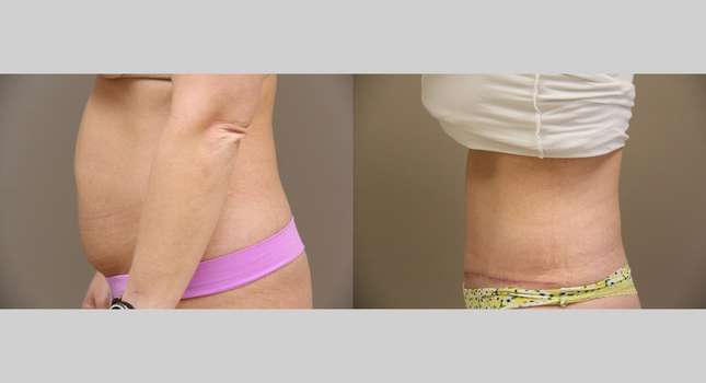 Tummy Tuck: Image #768
