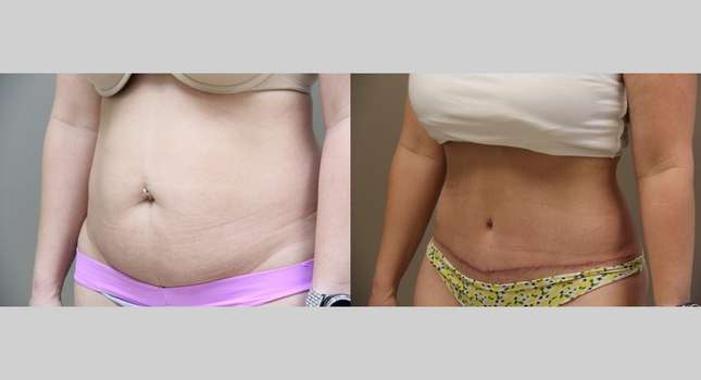 Tummy Tuck: Image #769