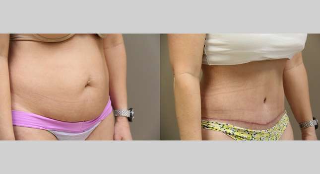 Tummy Tuck: Image #770
