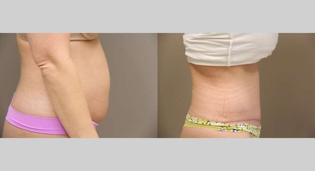 Tummy Tuck: Image #771