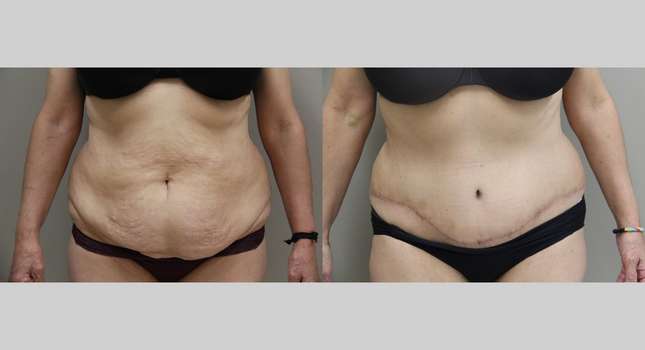 Tummy Tuck: Image #798