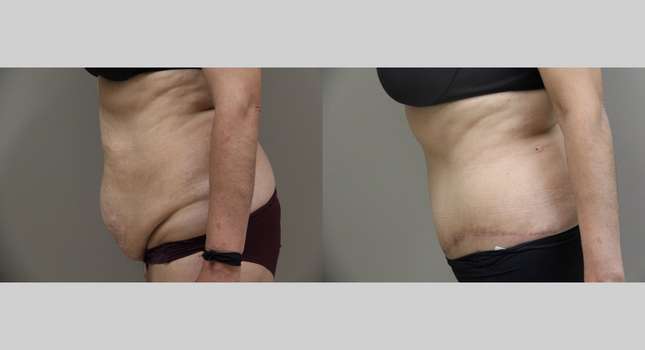 Tummy Tuck: Image #800