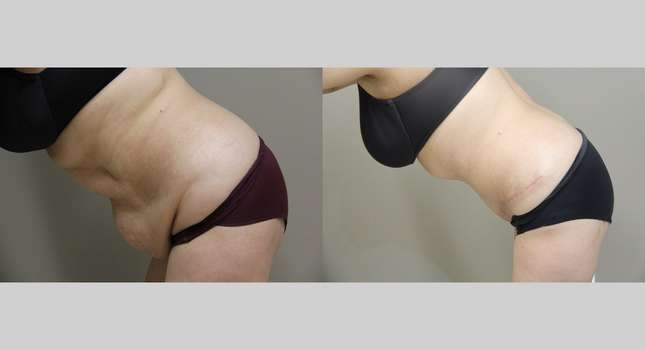 Tummy Tuck: Image #801
