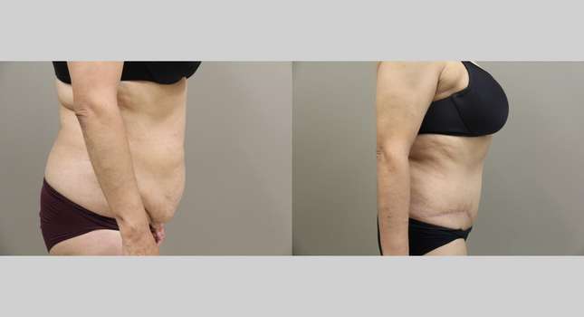 Tummy Tuck: Image #803