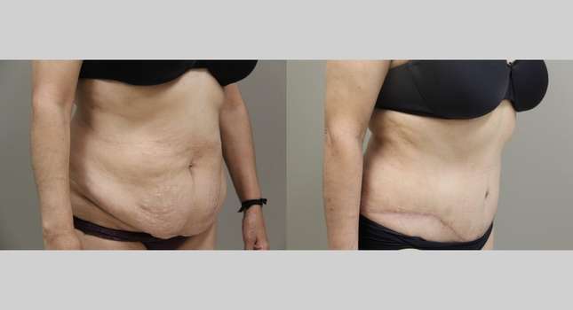 Tummy Tuck: Image #804