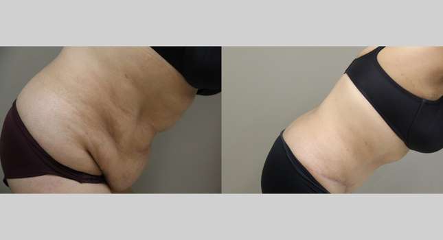 Tummy Tuck: Image #805