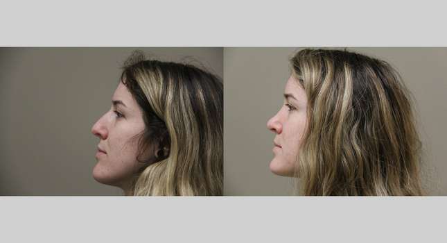 Nose Surgery: Image #806
