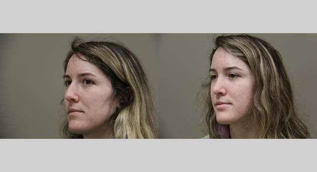 Nose Surgery: Image #807