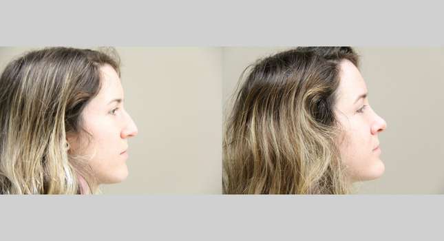 Nose Surgery: Image #808