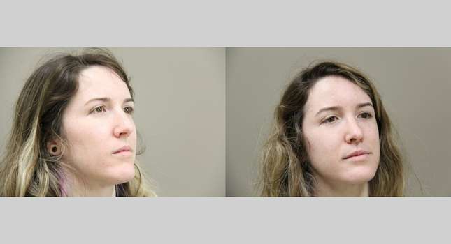 Nose Surgery: Image #809