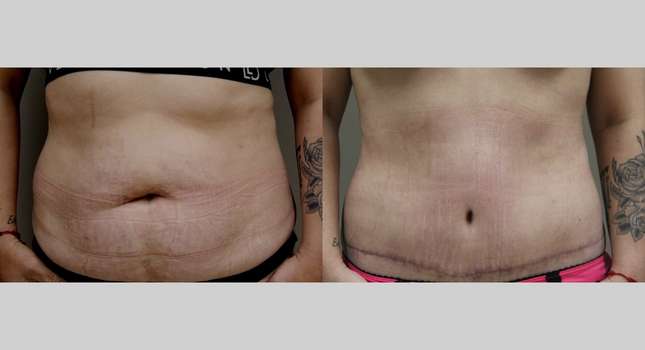 Tummy Tuck: Image #831