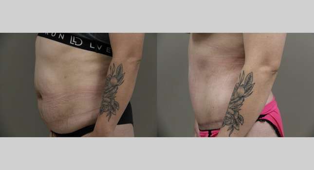 Tummy Tuck: Image #832