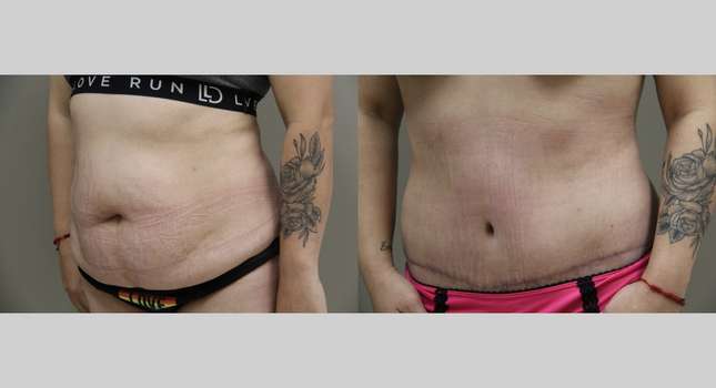 Tummy Tuck: Image #833
