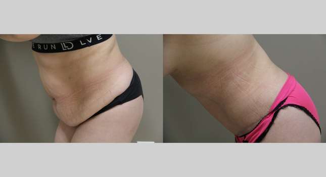 Tummy Tuck: Image #834