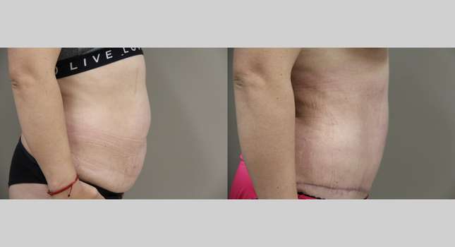 Tummy Tuck: Image #835