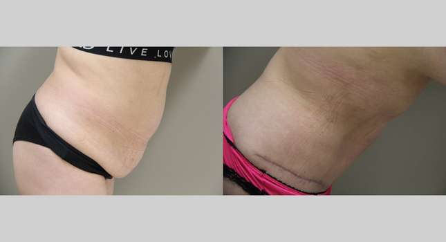 Tummy Tuck: Image #836