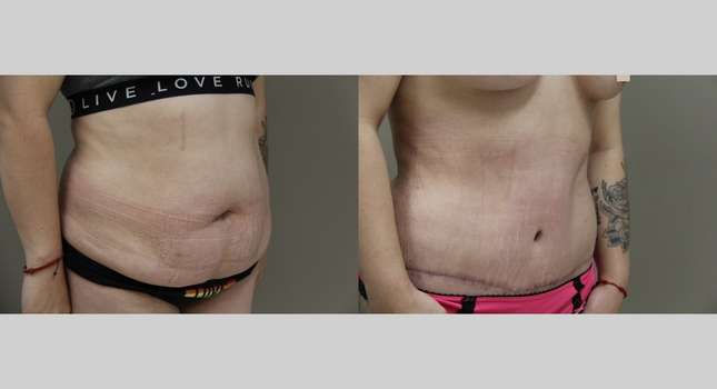 Tummy Tuck: Image #837