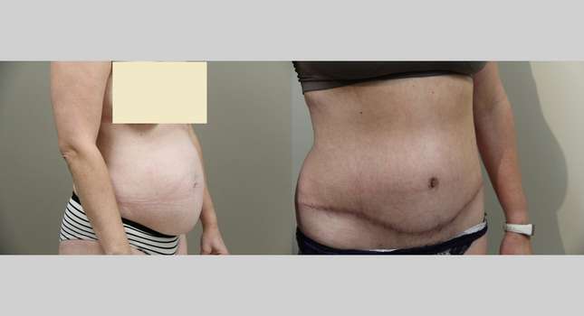 Tummy Tuck: Image #838