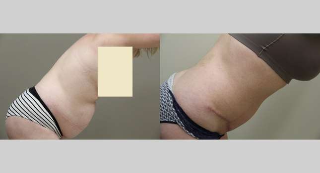Tummy Tuck: Image #839