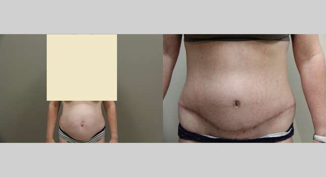 Tummy Tuck: Image #840