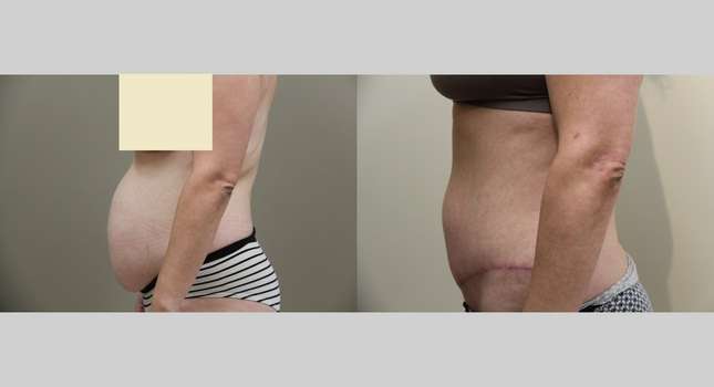 Tummy Tuck: Image #841
