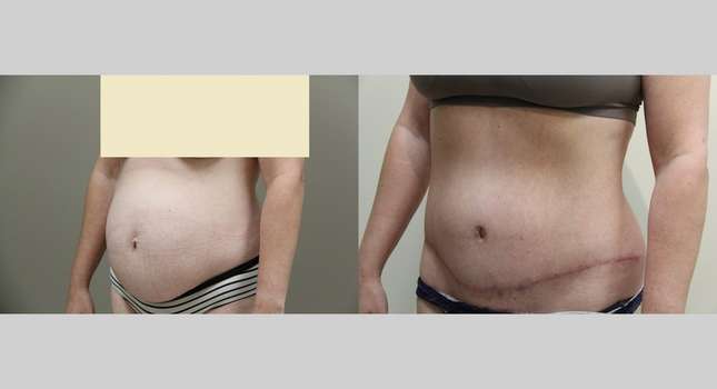Tummy Tuck: Image #842