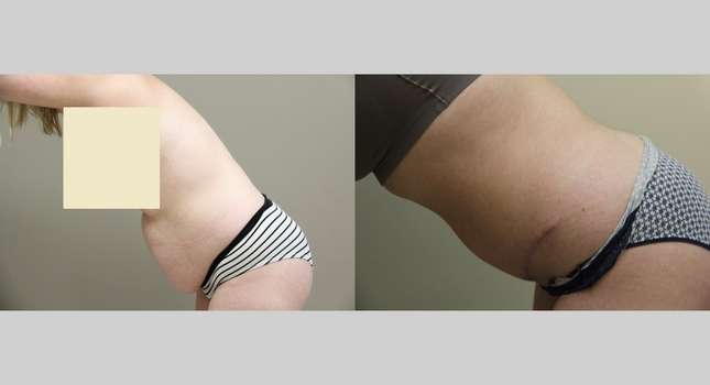 Tummy Tuck: Image #843