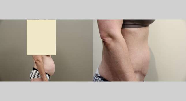 Tummy Tuck: Image #844