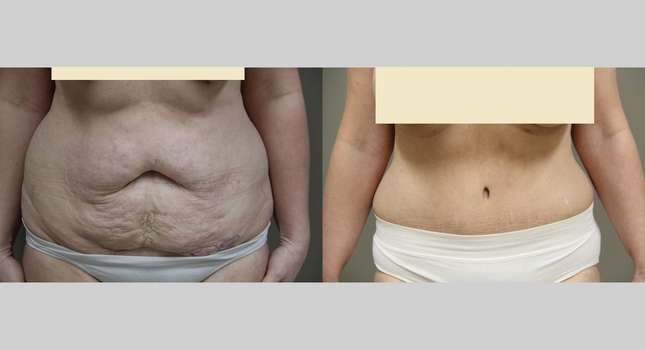 Tummy Tuck: Image #845