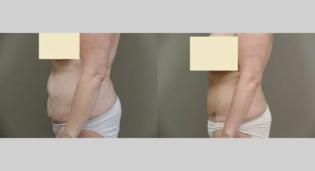 Tummy Tuck: Image #846