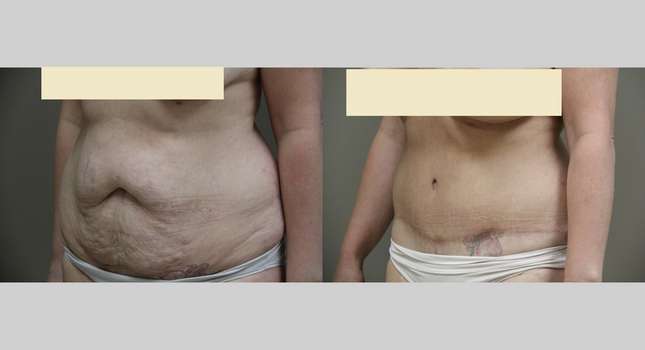 Tummy Tuck: Image #847